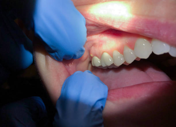 Best Emergency Dental Care for Broken or Chipped Teeth in Warrenton, VA